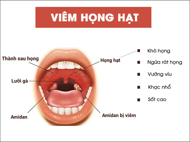 Viêm họng hạt và những triệu chứng cần lưu ý